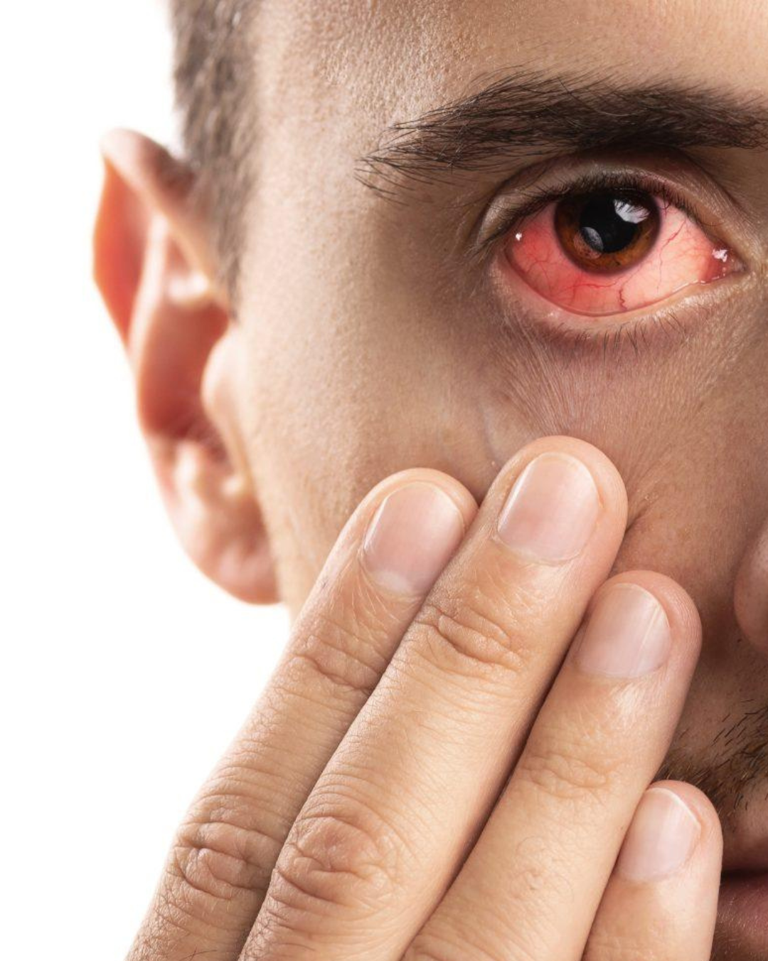 Red eye from conjunctivitis (pink eye).